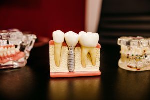 Ile kosztują implanty stomatologiczne?